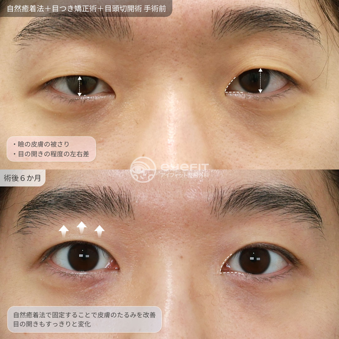 eyefit_kr's tweet photo. アイフィット自然癒着法＋目つき矯正術＋目頭切開
✔術後６ヶ月

・目の開きの左右差
・まぶたのたるみ
・眠たく見えるお目元
・蒙古襞の被さり

左右差を整え、自然な範囲で目の開きを改善✨
春イベント実施中🎀
お問い合わせ：https://t.co/FFJPxqxJXy
#韓国整形 #渡韓整形 #埋没 #目整形 #目頭切開 https://t.co/kGKc7HHgxg