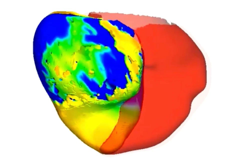 Matt_R_Fisher's tweet image. New #research shows potential impact of using #technology to create virtual twin of #patient. Can then experiment and find way to helping condition. apnews.com/article/heart-… #healthIT