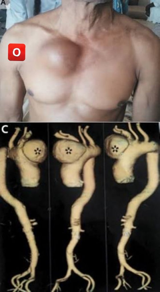 DoctorDatos's tweet photo. @TrackYourHeart 🅾️ Cardiovascular tertiary syphilis may lead to aortitis, aortic aneurism, coronary stenosis, aortic insufficiency and, rarely, to myocarditis. The physician must be familiar with the clinical presentations of this process.  #Doctors https://t.co/3BVLOWsId5