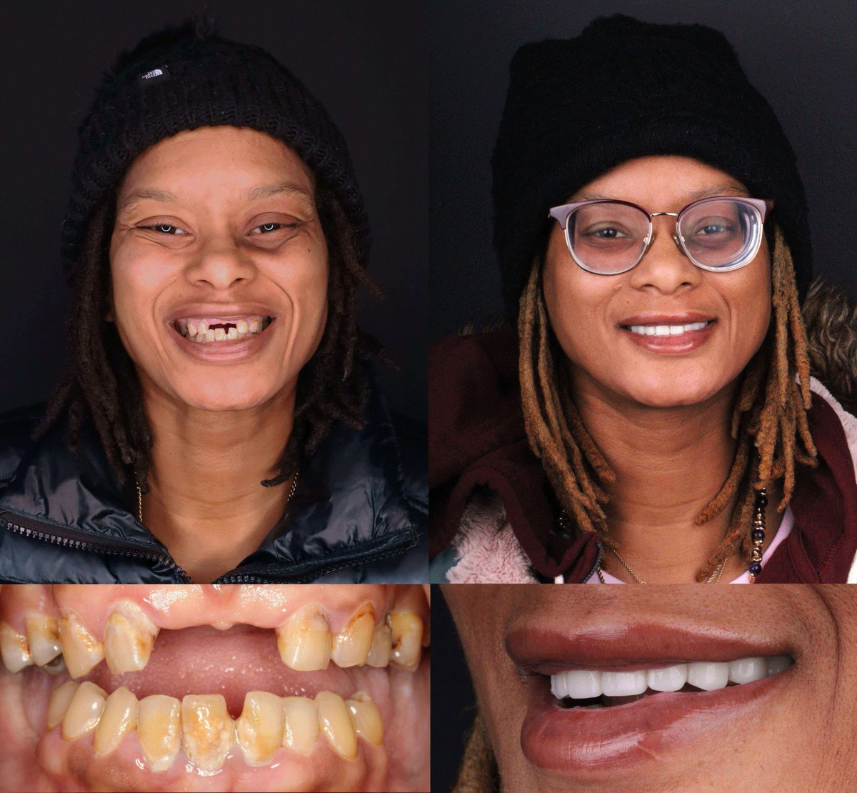drshawnkeller's tweet image. One day changed everything.

She came in tired of “making it work.”
She left with a smile that finally fits her life.

Same Day New Smile.
Confidence restored. Function rebuilt. Life upgraded.

📞 Ready when you are.

#SameDayNewSmile #DentalImplants #SmileTransformation