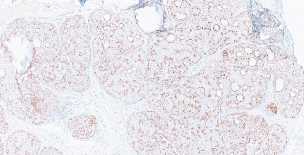 Janiranavarro's tweet image. Atypical lobular hyperplasia (ALH) involving collagenous spherulosis

E-cadherin (pic 3)

Dr. Cimino-Mattews #USCAP2026 #pathology #PathX #PathTwitter