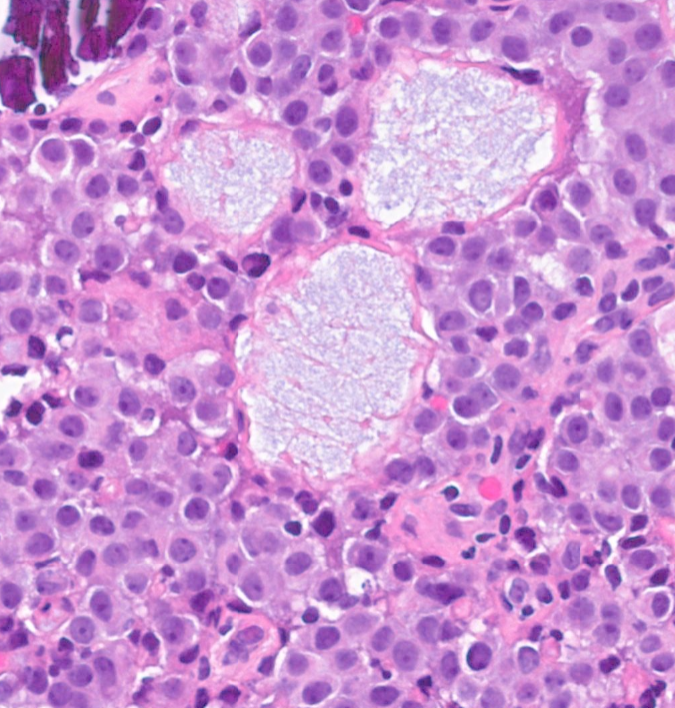 Janiranavarro's tweet image. Atypical lobular hyperplasia (ALH) involving collagenous spherulosis

E-cadherin (pic 3)

Dr. Cimino-Mattews #USCAP2026 #pathology #PathX #PathTwitter
