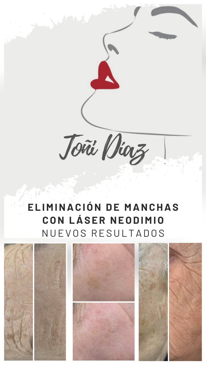 esteticatonidia's tweet photo. ✨️ Nuevos Resultados Eliminación de Manchas con nuestro Láser de Neodimio

Consúltanos sin compromiso.
Centro de Estética Toñi Díaz. 
#manchasfaciales #laserfacial #pielluminosa #esteticafacial
[eliminación de manchas, láser neodimio, tono uniforme, hiperpigmentación] https://t.co/AxQuYxH3zA