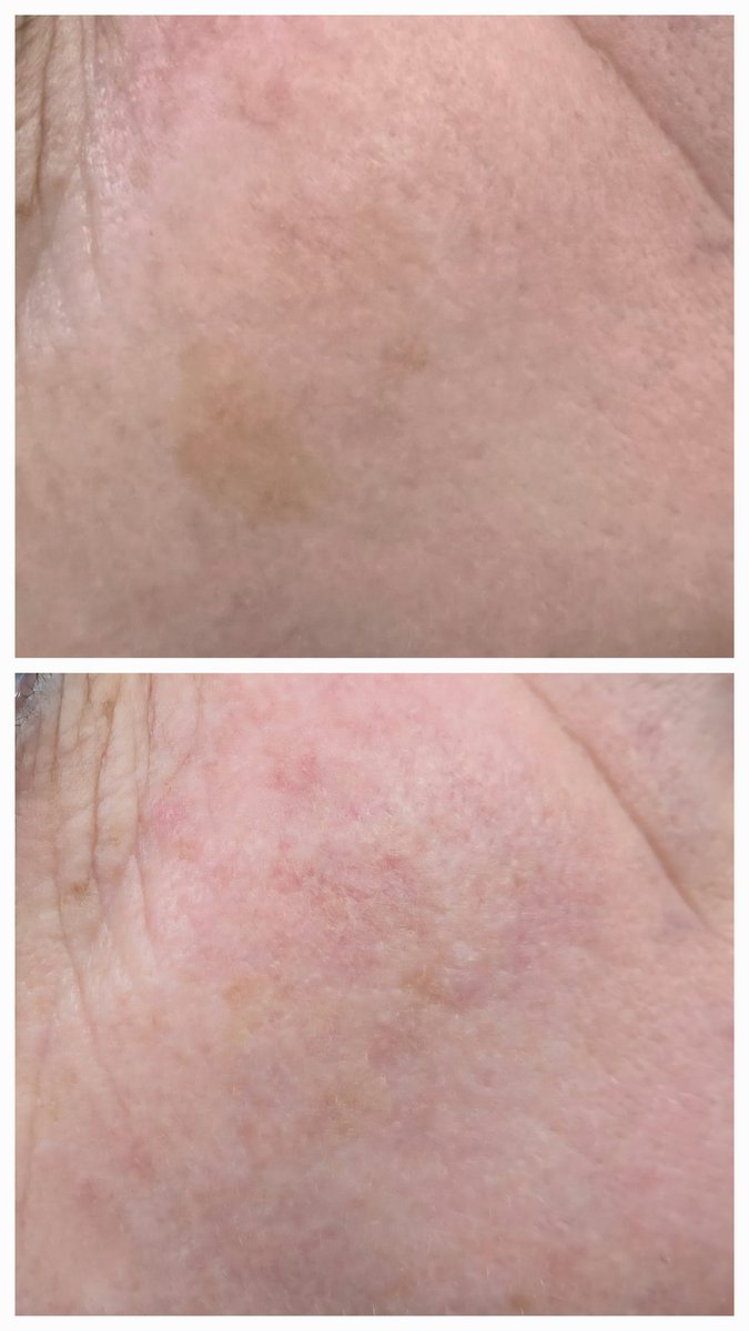 esteticatonidia's tweet photo. ✨️ Nuevos Resultados Eliminación de Manchas con nuestro Láser de Neodimio

Consúltanos sin compromiso.
Centro de Estética Toñi Díaz. 
#manchasfaciales #laserfacial #pielluminosa #esteticafacial
[eliminación de manchas, láser neodimio, tono uniforme, hiperpigmentación] https://t.co/AxQuYxH3zA