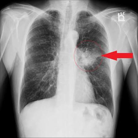 DrAyubaD's tweet image. BANGER CASE 🔥🔥🔥🔥

CIGARETTES SMOKER WITH HEMOPTYSIS( COUGHING BLOOD) +WEIGHT LOSS.

WHAT IS THE RED ARROW POINTING AT?

#RadRes #RadTwitter #Radiology