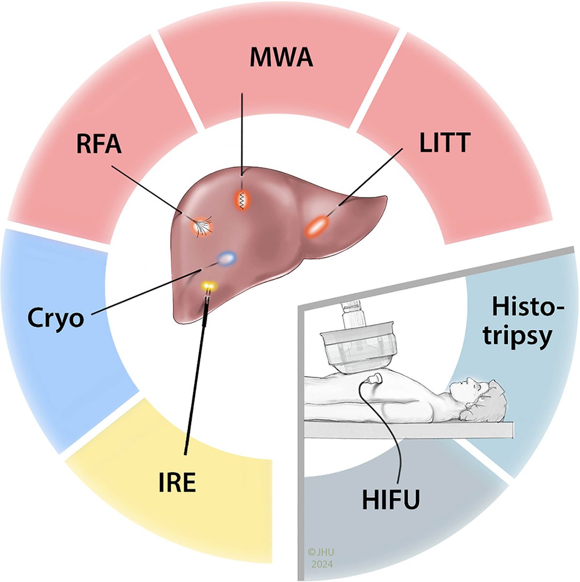 radiology_rsna's tweet photo. Is ablation redefining liver tumor care? See advantages over resection and expanding roles for thermal &amp; nonthermal techniques combined with systemic therapy, immunotherapy &amp; AI guidance @ConnorCentner @GeorgiadesMD @MarkYarchoan @DrCliffWeiss @Hopkins_Rad https://t.co/anqVn2V1Y2 https://t.co/kMRU9tmB2g
