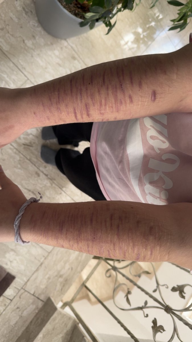 blu33rays's tweet photo. scars check lol
purpul cuz im cold

#shtwt #shedtwt #mootme #scars https://t.co/7nxur6fgzC