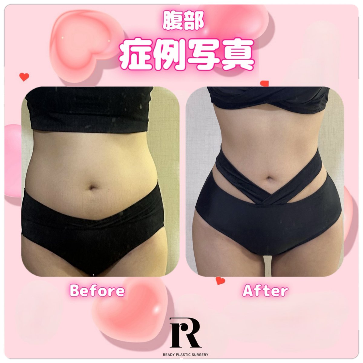 READY PLASTIC SURGERY🎀(#脂肪吸引 #移植専門)整形外科専門医 tweet media