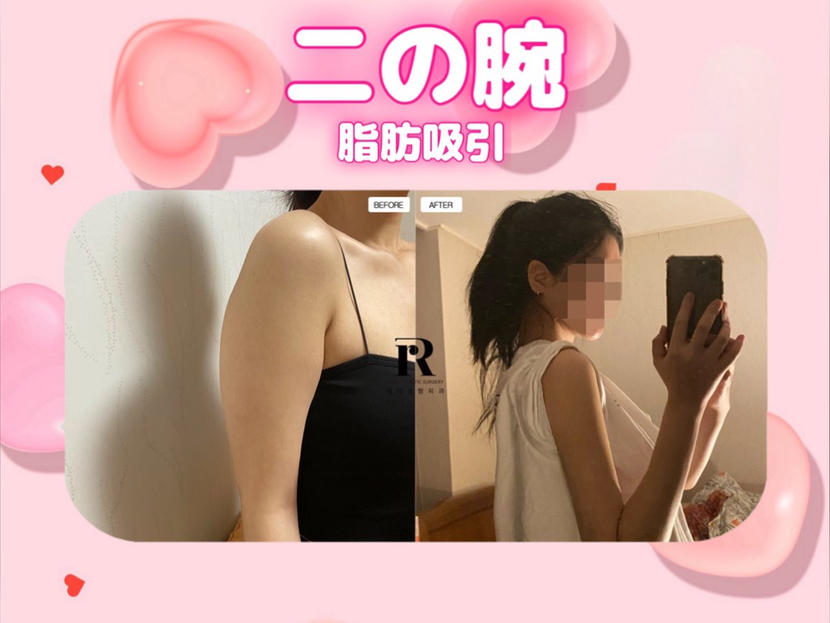 READY PLASTIC SURGERY🎀(#脂肪吸引 #移植専門)整形外科専門医 tweet media