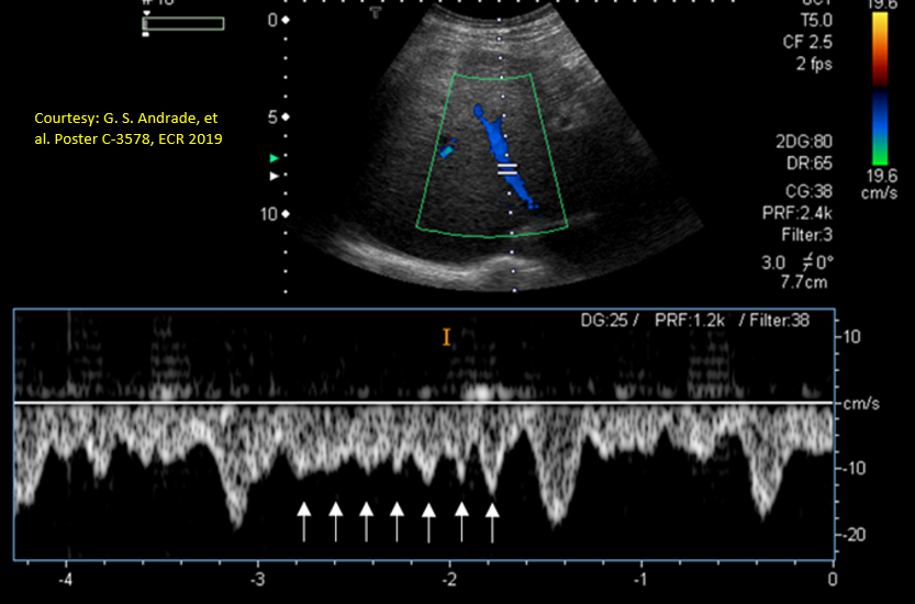 NephroP's tweet photo. What do these waves likely indicate on this hepatic vein Doppler?
#VExUS #POCUS https://t.co/jIqQtkYMT0