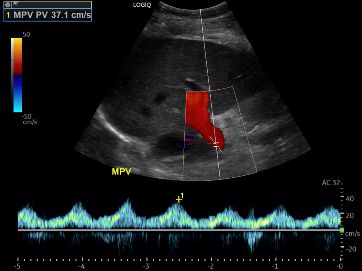 NephroPOCUS tweet media
