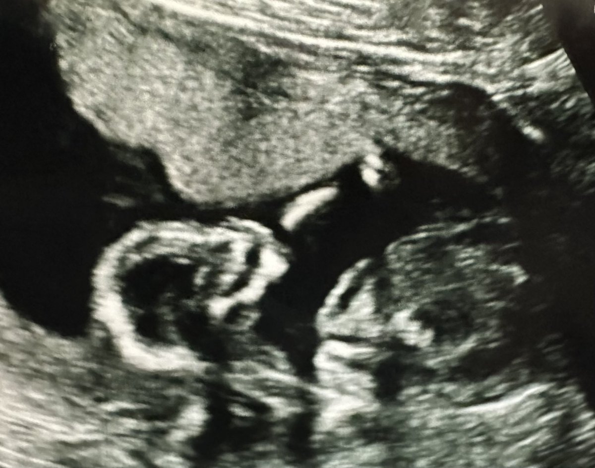 AconitePrincess's tweet photo. My little fifteen week anterior placenta baby 💜💜 https://t.co/puehe1WjQJ