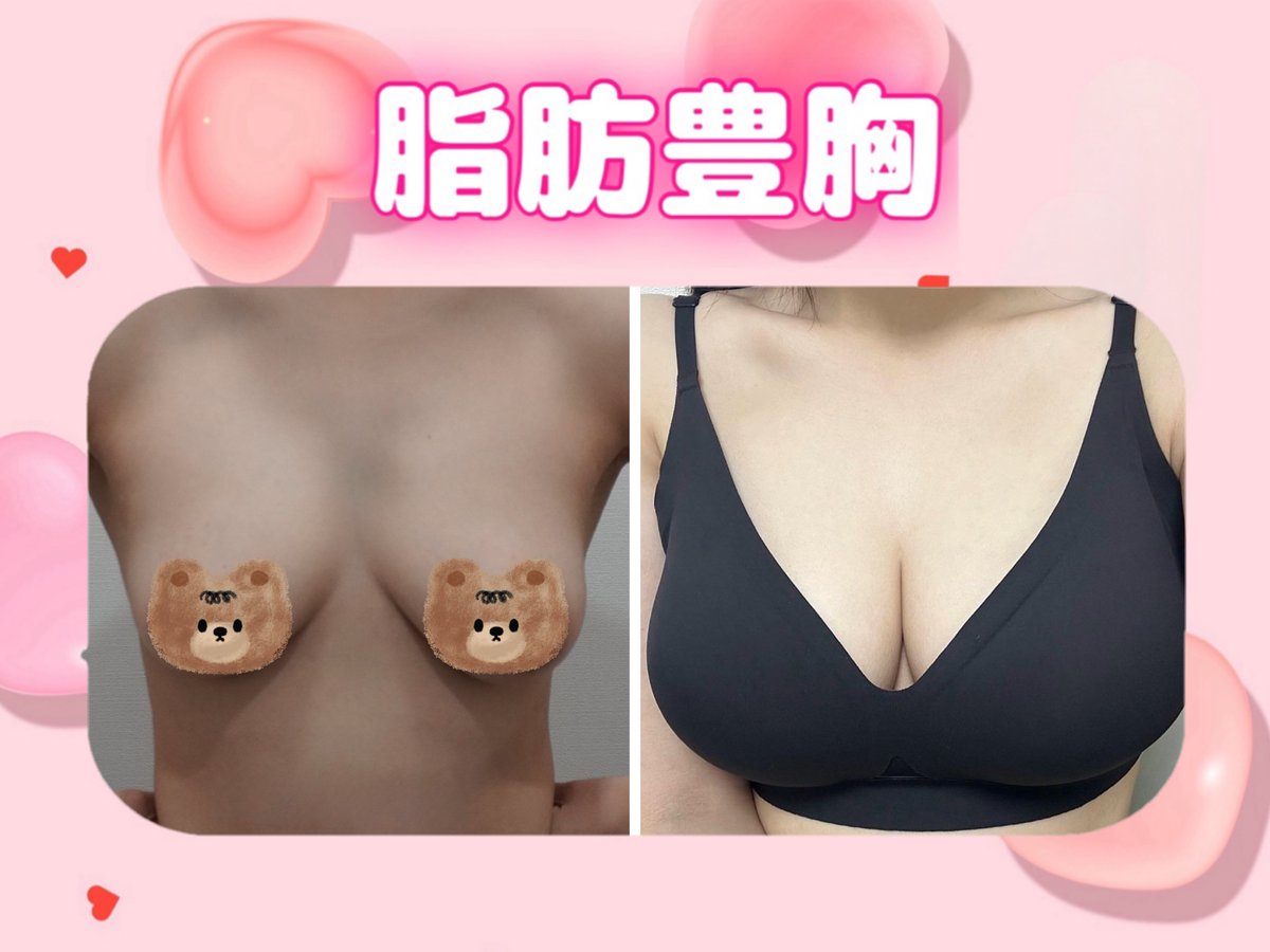 READY PLASTIC SURGERY🎀(#脂肪吸引 #移植専門)整形外科専門医 tweet media
