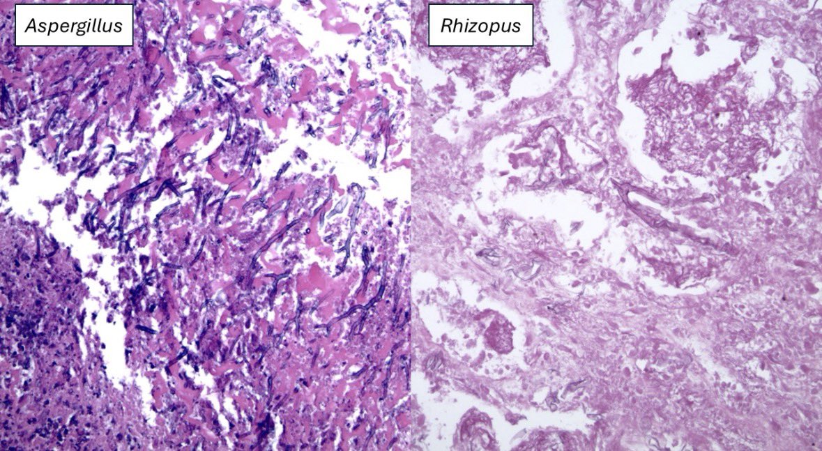 Is fungal pathology in the 21st pathology all about just writing a comment that says you're going to defer to cultures? 

Read this paper for a more nuanced approach: 
pubmed.ncbi.nlm.nih.gov/41248033/