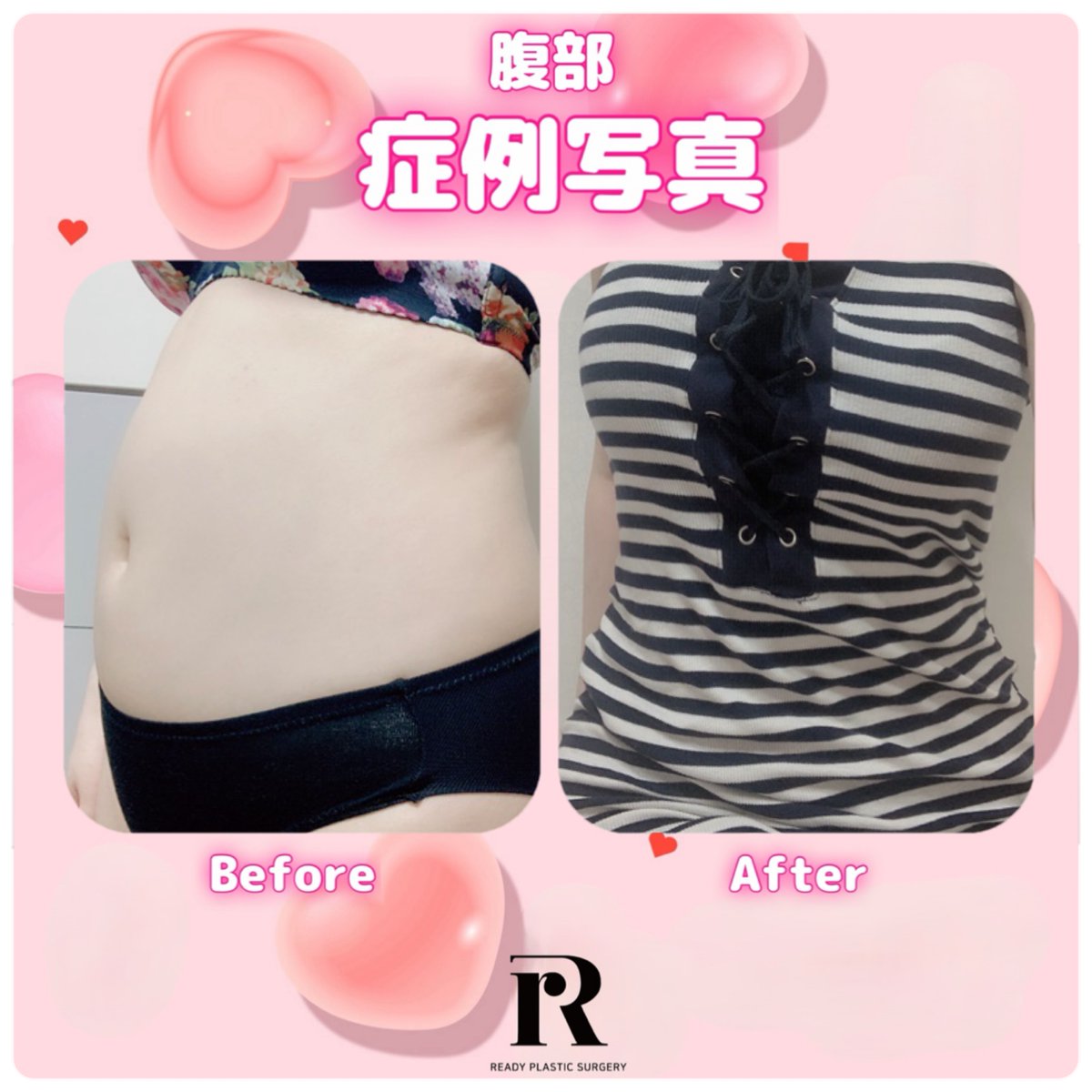 READY PLASTIC SURGERY🎀(#脂肪吸引 #移植専門)整形外科専門医 tweet media