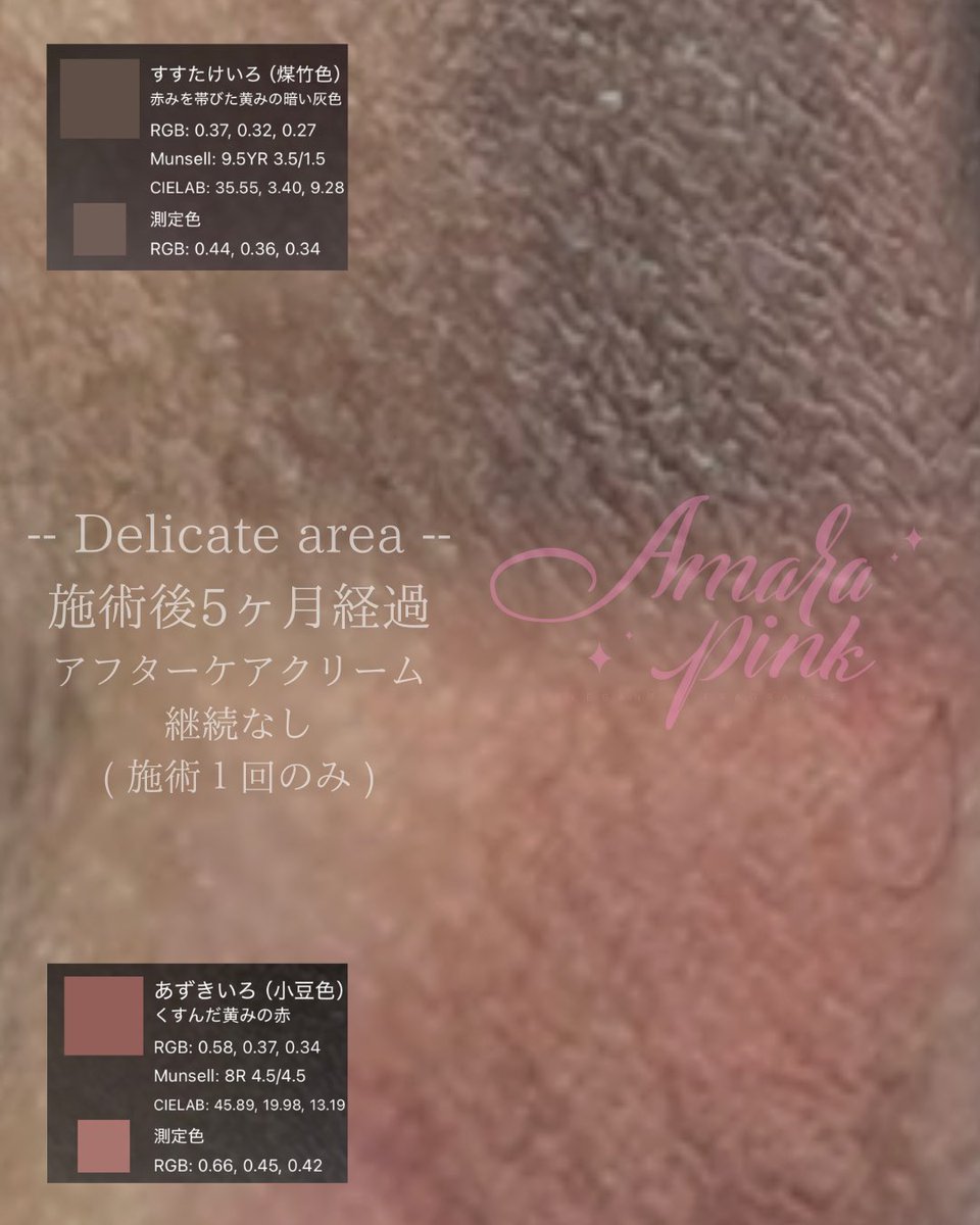 tmm_art11's tweet photo. アマラピンク導入して1年が経過したので、メンテナンスを受けにきてくださる方も増えてきました。
刺激や摩擦、紫外線でメラニンはつくられてしまい蓄積していきます。
特に妊娠をすると女性ホルモンの影響で黒ずみがさらに濃くなります。
コンプレックスや悩まれている方は、検討してみて欲しい！ https://t.co/cyTJEq8DFM