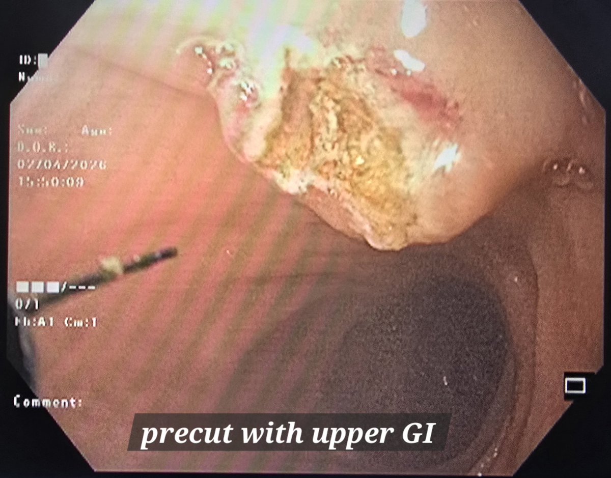 raghuyar's tweet image. Case of post subtotal cholecystectomy-bile leak-duodenal narrowing due to chronic DU and ongoing inflammation-no response to CRE dilatation-no IHBD &amp;amp; poor duodenal window for EUS RZV.Only scope that reaches papilla-Upper GI without cap-failed cannulation.#ERCPUGIscope #precut #GI