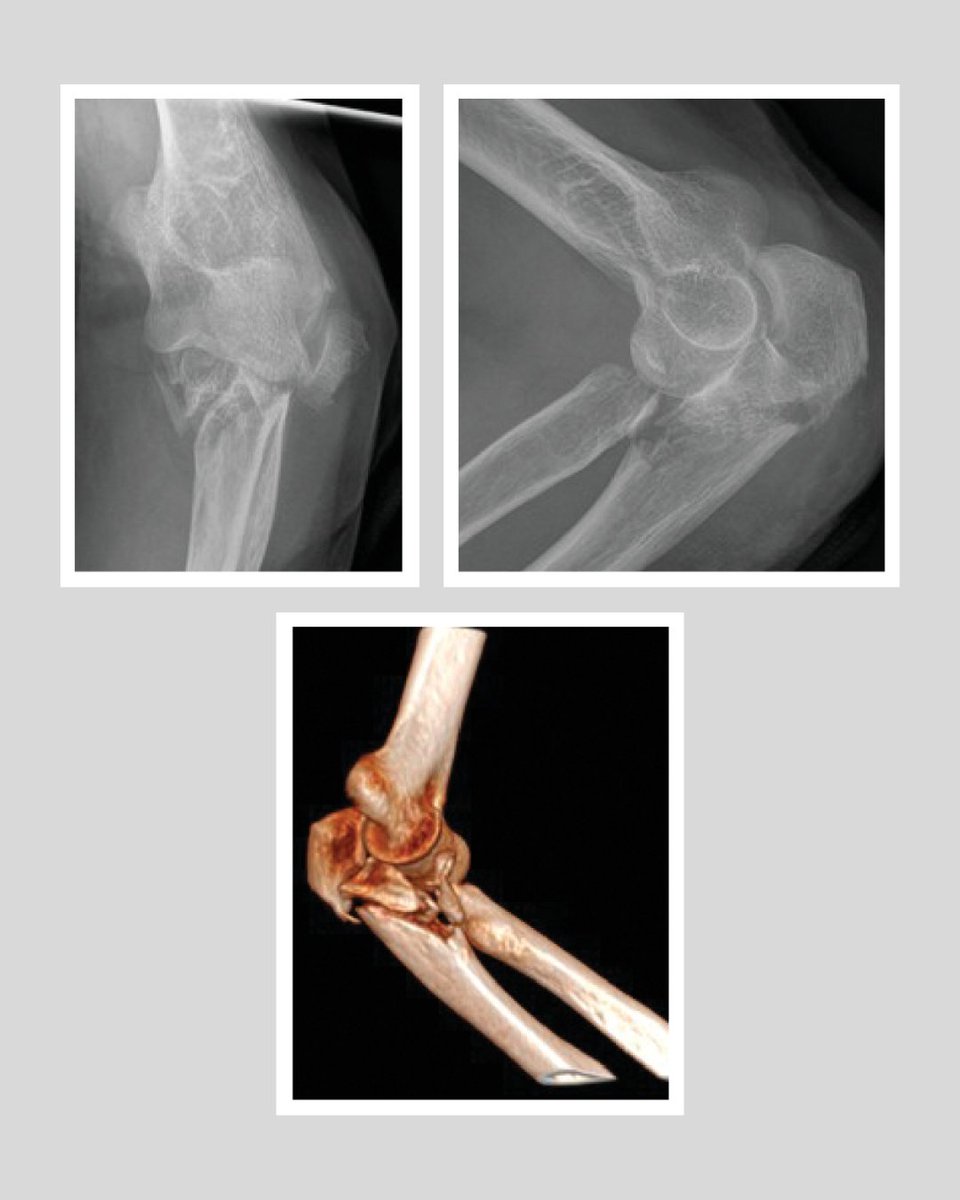 BoneJointJ's tweet image. The ‘terrible triad’ concept has meant that some very complex elbow fracture-dislocations are considered alongside more benign injuries, leading to problems with our understanding and interpretation of the literature.

#Elbow #Trauma @DuckworthOrthEd

ow.ly/AV5e50YCiVG