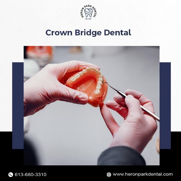 Heronpark_'s tweet image. When your smile needs extra support, crown bridge dental solutions at Heron Park Dental help restore confidence with results that look and feel completely natural.

#CrownBridge #SmileCare #DentalSolutions #OttawaDentist #HeronParkDental