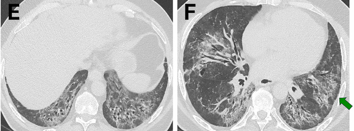 Dx_imaging's tweet image. Study Examines Key CT Features for Differentiating Fibrotic Interstitial #LungDisease
diagnosticimaging.com/view/study-key…
@RadiologyACR @ARRSResidents @RSNA @YaleRadiology @PennRadiology @NYUImaging @thoracicrad @BrighamRad @UVARadiology @OSURadiology 
#radiology #RadRes #CTRad