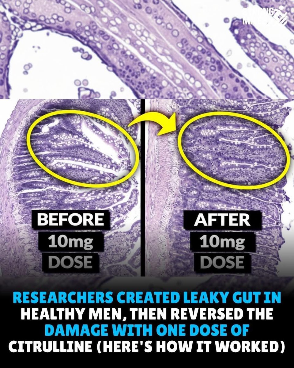 argosaki's tweet photo. 🔥 One 10g Dose of Citrulline SAVED Gut Lining in Healthy Guys During Intense Exercise – Rapid Blood Flow Protection in Under an Hour? Game-Changer for Stress-Induced Leaky Gut? 💪🩸 #Citrulline #GutHealth #LeakyGutFix #ExerciseRecovery #NitricOxideBoost
(Videos & Sources below 👇) A key 2014 study (published in Medicine & Science in Sports & Exercise) tested pre-exercise supplementation in 10 healthy young men. 
They took a single 10g dose of L-citrulline (or placebo) before 60 minutes of intense cycling at ~70% max workload, which normally reduces gut blood flow and causes intestinal stress/injury.
Results showed:
•Citrulline boosted plasma citrulline and arginine levels dramatically, increasing arginine availability for nitric oxide production.
•It prevented the typical drop in splanchnic (gut) blood flow during exercise (measured via gastric-arterial PCO2 gap – stayed stable vs. increased with placebo).
•Gut cell injury marker (plasma I-FABP) rose sharply in placebo but was significantly attenuated with citrulline (AUC reduced by ~185% vs. +1318% in placebo).
•No major change in intestinal permeability (sugar probe test) – likely because stress wasn’t extreme enough for full barrier breakdown, or citrulline acts upstream by preserving perfusion before damage escalates.

Citrulline works by bypassing liver breakdown (unlike direct arginine), raising systemic arginine/NO for better microcirculation without GI side effects. 

This acute protection highlights blood flow’s role in preventing stress-related gut issues (e.g., from workouts, heat, or sympathetic stress). 

It’s not a full “reversal” of established leaky gut but offers rapid preventive/resilience benefits.

Stacking ideas from experts: Pair with glutamine (for enterocyte fuel), zinc carnosine (local repair), or collagen (building blocks) for synergy. 
Always consult a doctor—especially for high doses or gut conditions. 
Promising for athletes or stress-prone digestion, but more research needed beyond this small crossover trial.
(Verified core findings from PMID: 24621960 / DOI: 10.1249/MSS.0000000000000256 – 
real study on exercise-induced gut compromise.)
Videos :
March 2026 – Focus on Citrulline for Gut Protection/Blood Flow):
•https://t.co/5wYMGThs6W (“This Cheap Supplement Heals Leaky Gut After Just ONE DOSE” – Breaks down the study mechanism, blood flow preservation, reduced I-FABP, and why citrulline prevents damage upstream)
•https://t.co/d5k7j4YSBY (Explains citrulline boosting nitric oxide for better blood flow/artery relaxation – touches on broader circulation benefits, including potential gut implications during stress/exercise.)

Note: 
Videos often reference this 2014 study or similar NO/gut perfusion research—it may be informative but it’s not medical advice.

Verified Sources: Primary study (2014 crossover trial on L-citrulline preserving splanchnic perfusion & reducing gut injury during exercise):
•PubMed: https://t.co/R5vBNoObie
•Full text/PMC: https://t.co/MsUdxqBSkh (open access PDF available)
•Journal abstract: https://t.co/R41vgCNH9a
Related reviews/context:
•Systematic review on supplements for exercise-induced gut damage (includes citrulline benefits): https://t.co/Wq8Li0OrhB
•Broader citrulline exercise/gut discussion: https://t.co/EAwJJBHHTC
The “reverses leaky gut” stem from Boxlife Magazine article (https://t.co/Ahxt5Fyxwg) summarizing this study, but the research shows prevention/attenuation of injury via perfusion, not full reversal of chronic leaky gut. 

Solid evidence for acute protection in exercise stress—consult pros for personal use! 🧬🏋️‍♂️