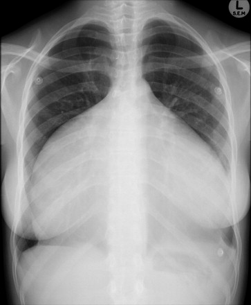 drsthanus's tweet photo. A woman in her late teens presented  severe dyspnoea and palpitations.

 Thoughts? https://t.co/EhLOhiNzcM