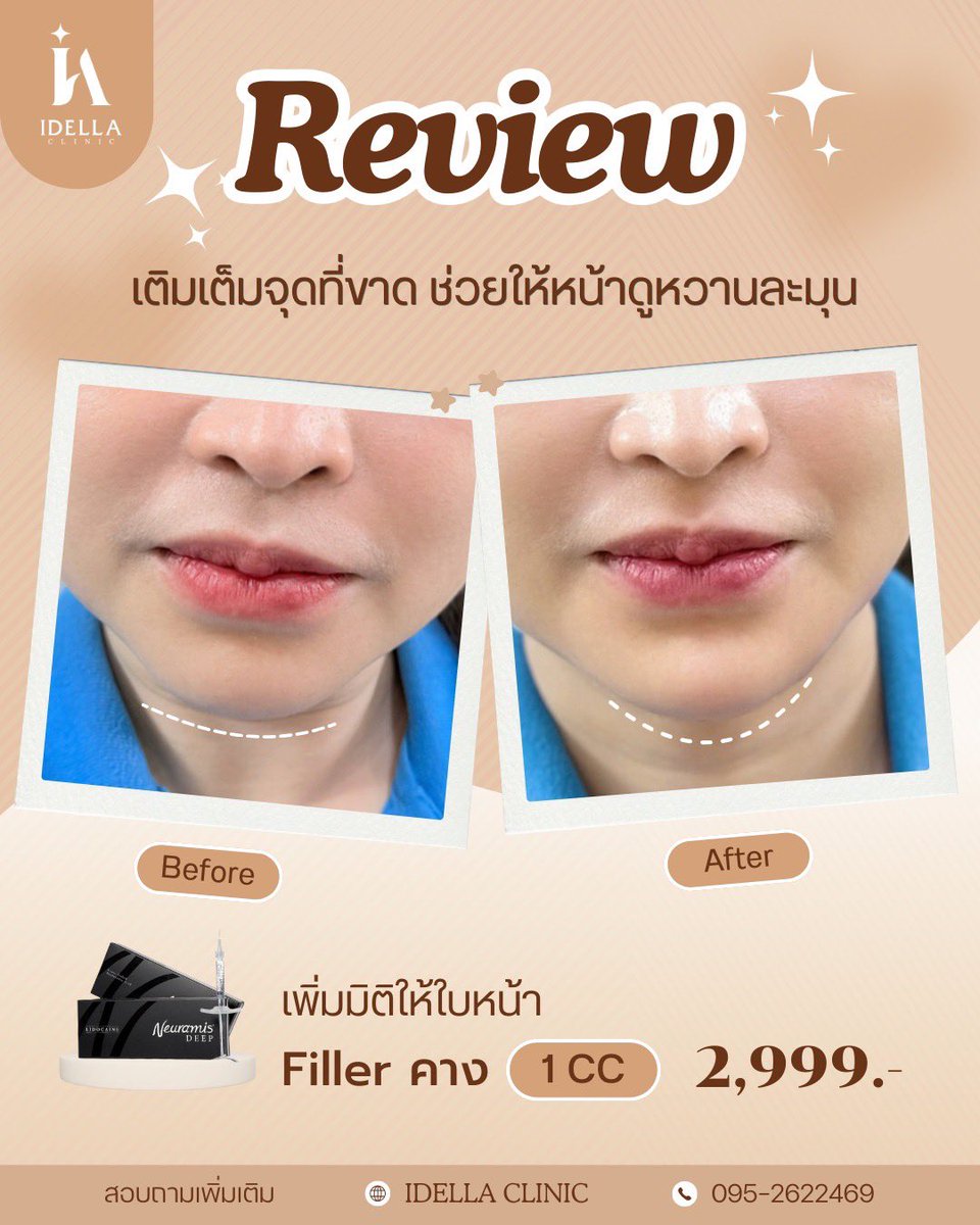 idellaclinic's tweet photo. หลายๆคนอาจไม่รู้ว่า “คาง” คือจุดสำคัญที่ช่วยปรับรูปหน้าให้ดูสมส่วน เปลี่ยนลุคให้หน้าดูละมุนขึ้น
จากเคสนี้‼️
ก่อนทำจะเห็นว่าช่วงคางยังสั้นเล็กน้อยทำให้หน้าดูตัด แต่หลังเติม... #ฟิลเลอร์คาง เพียง 𝟭𝗰𝗰 รูปหน้าดูยาวขึ้นอย่างเป็นธรรมชาติ หน้าดูหวาน ละมุน และมีมิติมาก
#idellaclinic https://t.co/Yslpmqok1R