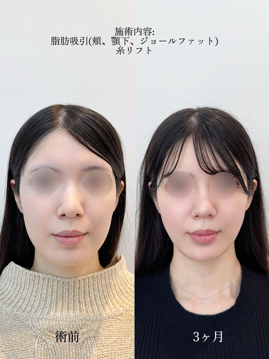 dr_tomo___'s tweet photo. 【余白と凹凸の問題☝️💡】

垢抜ける顔は、「凹凸がある顔」ではなく、“なめらかな曲線“の顔なんです。

顔が垢抜けない原因のひとつが
この“波��つ輪郭”👇

・こめかみ → 凹
・頬骨 → 凸
・頬こけ → 凹
・ジョールファット／バッカル など→ 凸

この凹凸の連続で、
フェイスラインが波打ち、顔の大きさや老け感を生み出します。

✔ 余分な脂肪は取る
✔ 必要な部分は補う

で整えていくと、
輪郭がなめらかな曲線になります。

すると結果的に

→ フェイスラインが締まる
→ 顔の余白が減る
→ 自然とV字輪郭に見える。