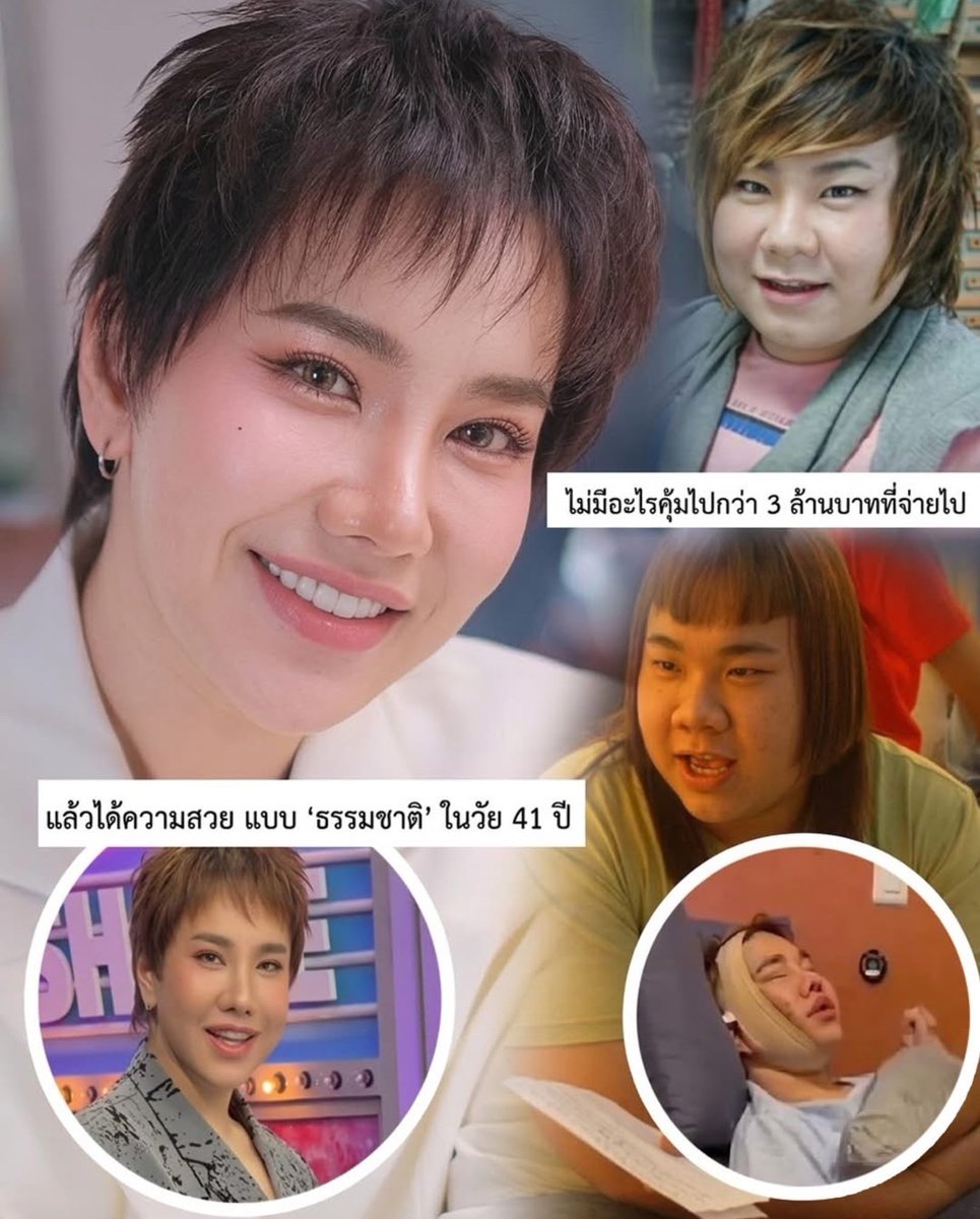 3 ล้านบาท 💥💥ที่แลกมาด้วย "วินัย" ในวัย 41 ปี ที่สวยที่สุดของ "บุ๊คโกะ" เจ้าแม่ศัลยกรรม 

คงไม่มีใครเชื่อว่าในวัย 41 ปี "บุ๊คโกะ" จะกลับมาดูเด็กเป็นธรรมชาติได้ขนาดนี้ กับการลุงทุนจมูกใหม่ในรอบ 10 ปี ที่บินไปไกลถึงเกาหลีด้วยงบกว่า 3 ล้านบาท

 แต่สิ่งที่น่าชื่นชมกว่าความสวย คือ