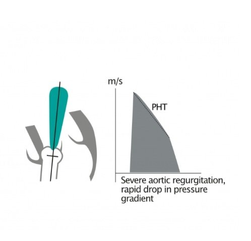 Ahmedata7777's tweet photo. Pressure Half-Time (PHT) in Aortic Regurgitation.

📉 Physiological Concept

● In severe AR → rapid equalization of pressures → steep deceleration slope → short PHT.
● In mild AR → slower equalization → flatter slope → long PHT.

📊 Severity Grading

● Mild > 500 ms
● Moderate 200–500 ms
● Severe < 200 ms

🧠 Key Pearls:

● Short PHT = worse AR.
● <200 ms strongly suggests severe AR, but confirm with other parameters.
● Particularly useful when jet is central and well visualized. 

 #cardiology #medicine