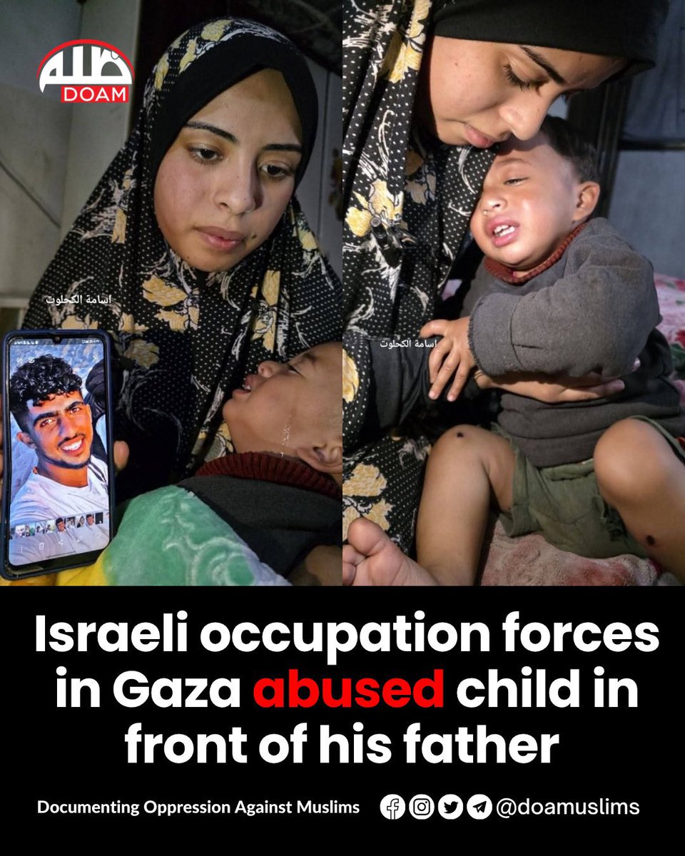 ShandanaGulzar's tweet photo. The Israeli forces tortured the Palestinian 1 year old baby in front of his father, by burning the baby’s legs with cigarettes, by pricking, and inserting a metal nail into the baby’s leg, as confirmed by a medical report. https://t.co/djIvzbMSj3