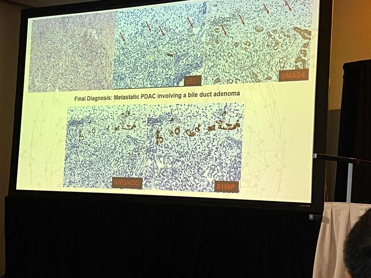 Mvgs1706's tweet photo. 🤯🤯🤯 Metastatic PDAC involving bile duct adenoma!!! @zhang_xuchen @pbpath #uscap2026 https://t.co/UiYRVCjhus