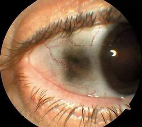 hemo_shk's tweet image. #Sign

What is the diagnosis?