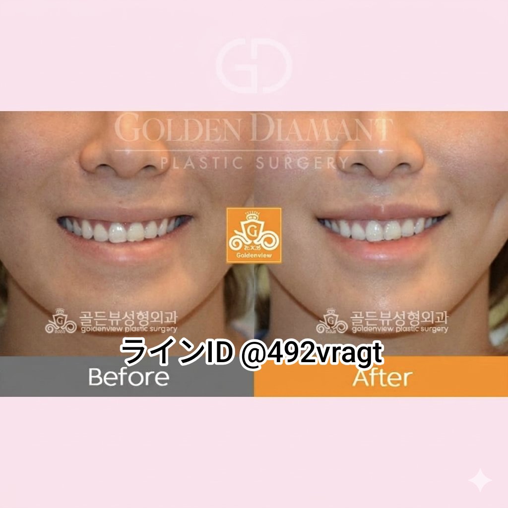 goldendiamantps's tweet photo. 人中縮小はただ皮膚を整えるだけだと 術後に後戻りしたり、口元が下がって見えることも

ゴールデンディアマントは人中縮小と微笑唇デザインを組み合わせながら、 深層の口輪筋から丁寧に引き上げて固定
さらに唇角まわりまで細かく調整し笑っていない時もやわらかい口元へ
長さ、比率と動きも整える https://t.co/ddrLYqQc5F