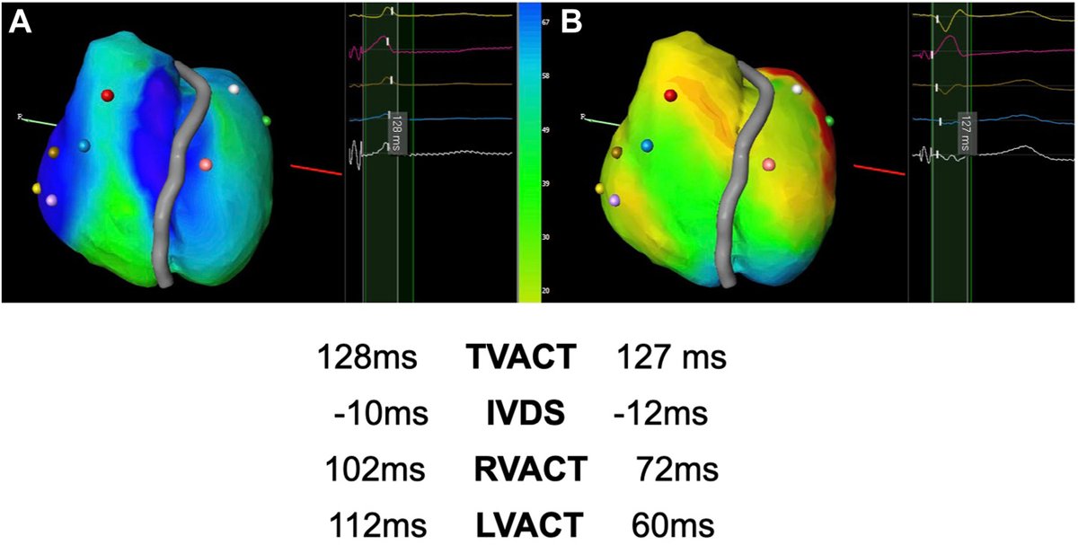 gautamsand's tweet photo. .@hrs_journal  AI is rapidly reshaping electrophysiology—from prediction to procedural guidance to ablation strategy.
🧵Here are 3 recent studies in @hrs_journal  highlighting how AI may impact:
• AF prediction from ECGs
• Substrate-guided ablation outcomes
• Conduction system pacing precision