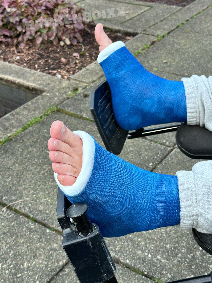 brokenboixx's tweet photo. Some casted foot pics https://t.co/wkCTy6jLyW