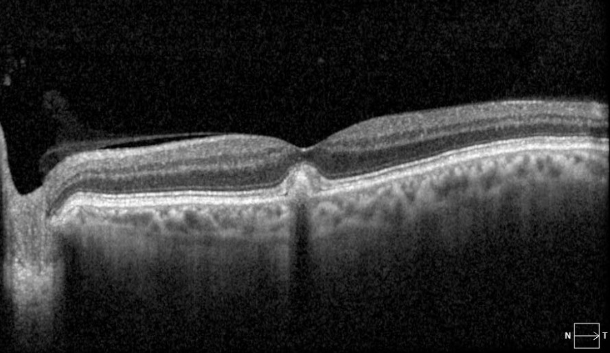 RetinaSociety's tweet photo. Adult-onset vitelliform macular dystrophy. https://t.co/bQKIKtUXJO