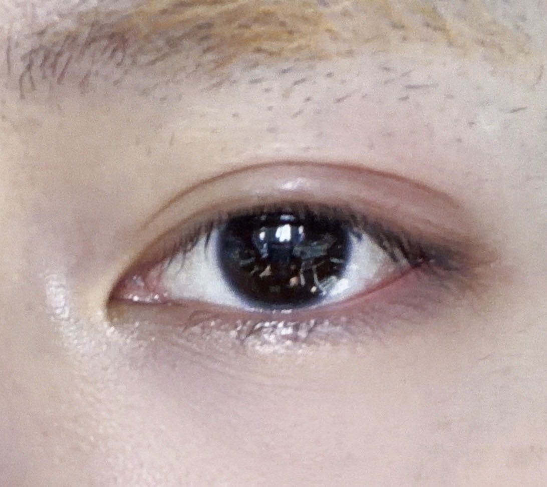 chenleveerse's tweet photo. 260323 | CHENLE BBL UPDATE 

chenle said bye to his stye 🥹 he went to the hospital and got it drained.

the doctor said it was kind of in between, like he could either leave it or drain it, but draining it would help it heal faster, so he decided to do it. 

he said this stage is actually the most painful and he said yeah, it really did hurt. but it was still bearable for him. 

he joked that jisung or mark probably couldn’t handle it, but for him this is his “teto” side there’s basically no pain he can’t endure 😭

and he was relieved that now he doesn’t have to worry about it for this week’s performances anymore

but then he was like now that it’s drained, it actually hurts even more. like whether he opens his eyes or keeps them closed, it just hurts anyway.

then he explained it like he went to the hospital and basically got it “popped”like they used a needle to pierce it and squeezed everything out and he was like “of course it hurts… but as a man, there’s no pain i can’t endure” 😭….get well soon lele 🫶🏻

#천러 #チョンロ #钟辰乐 #辰乐 #CHENLE
