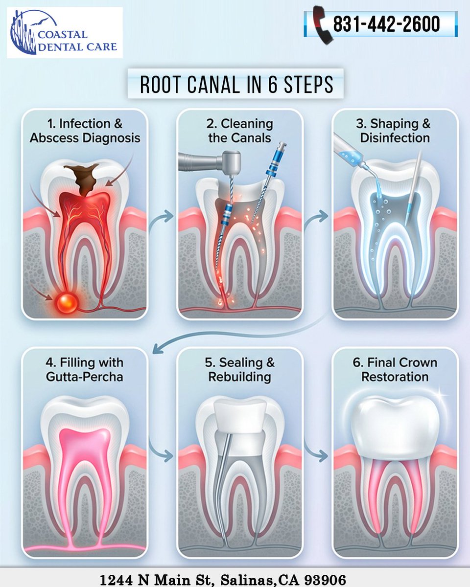 Coastaldcare's tweet image. Root canal: save your tooth, restore your smile 🦷
Schedule your Dental Consultation today!
Call: 831 442-2600
Book: coastaldentalcare.net/root-canal-end…
#ToothPain #RootCanalRelief #RootCanal #DentalCare #CoastalDentalCare #SalinasSmiles #Salinas #SalinasDentalCare #CoastalDentalSalinas