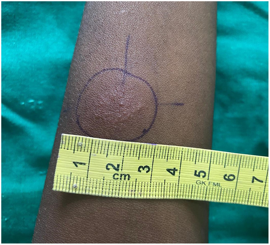 16-y-o Indian 👦: an 8-year history of asymptomatic, slowly progressive skin lesion over the left knee, well-defined erythematous scaly plaque with crusting, &amp; areas of atrophy &amp; scarring.

Tuberculin skin test: +++.
1/3

DOI: doi.org/10.4269/ajtmh.…
#medicine #dermatology