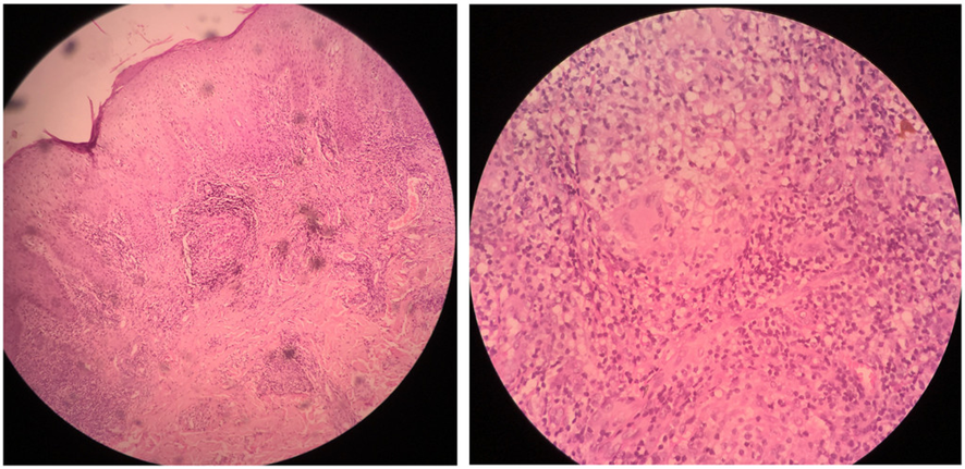 guerreroespejo's tweet photo. Biopsy: multiple well-formed epithelioid granulomas with or without giant cells surrounded by lymphocytic infiltrates in the dermis (Fig).
Ziehl-Neelson staining of the tissue, mycobacterial culture of a tissue specimen, and PCR for Mycobacterium tuberculosis: ➖.
2/3

#IDpost https://t.co/z0lr3JfnkL