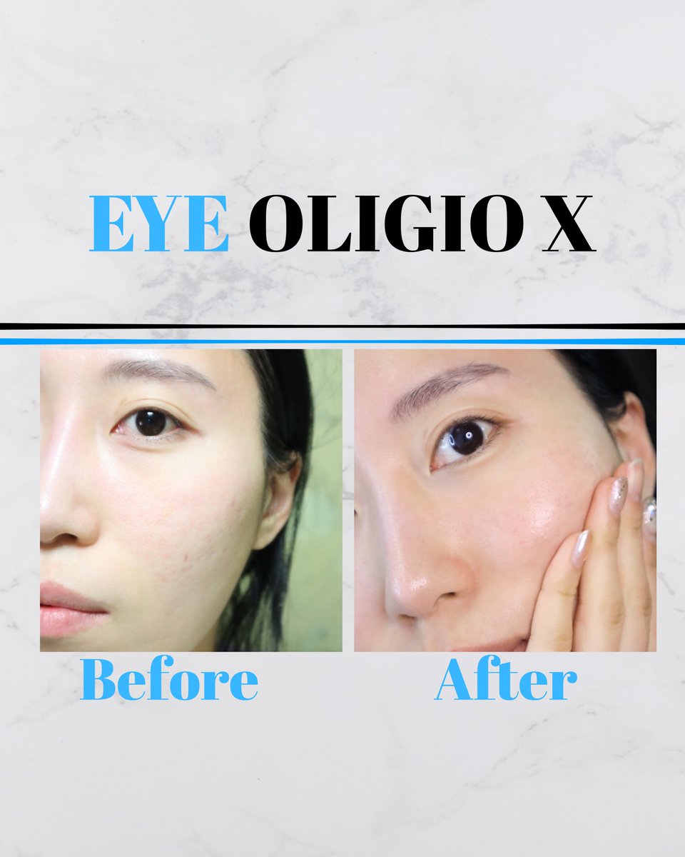 eclatdeusa's tweet photo. Today, I’m introducing a great Eye Oligio Lifting at Eclat de Cheongdam ✨

It lifts, smooths, and brightens the eyes naturally ! 
and… I’m thinking of trying it myself, haha! 💕

#EyeOligio #OligioLifting #CheongdamBeauty #NonSurgicalLift #KBeauty https://t.co/5ynXdd6CSm