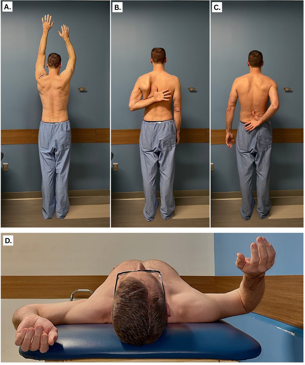 MoAImam's tweet image. Frozen Shoulder: Diagnosis and Treatment 👇

✅Clinical staging
✅Physical examination 
✅Representative physical therapy exercises

diabetes 👉greater disease severity and poorer response to standard treatments

#shoulder
sciencedirect.com/science/articl…