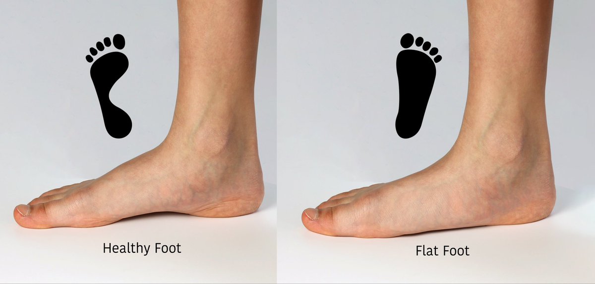 ليست كل حالات القدم المسطحة متشابهة

يجب التفريق بين النوع المرن و الصلب 
flexible rigid - flatfoot 

و هذا مهم جدًا لأن الخطة العلاجية تختلف جذريًا بينهما و مهم معرفة السبب لكل واحد منهم