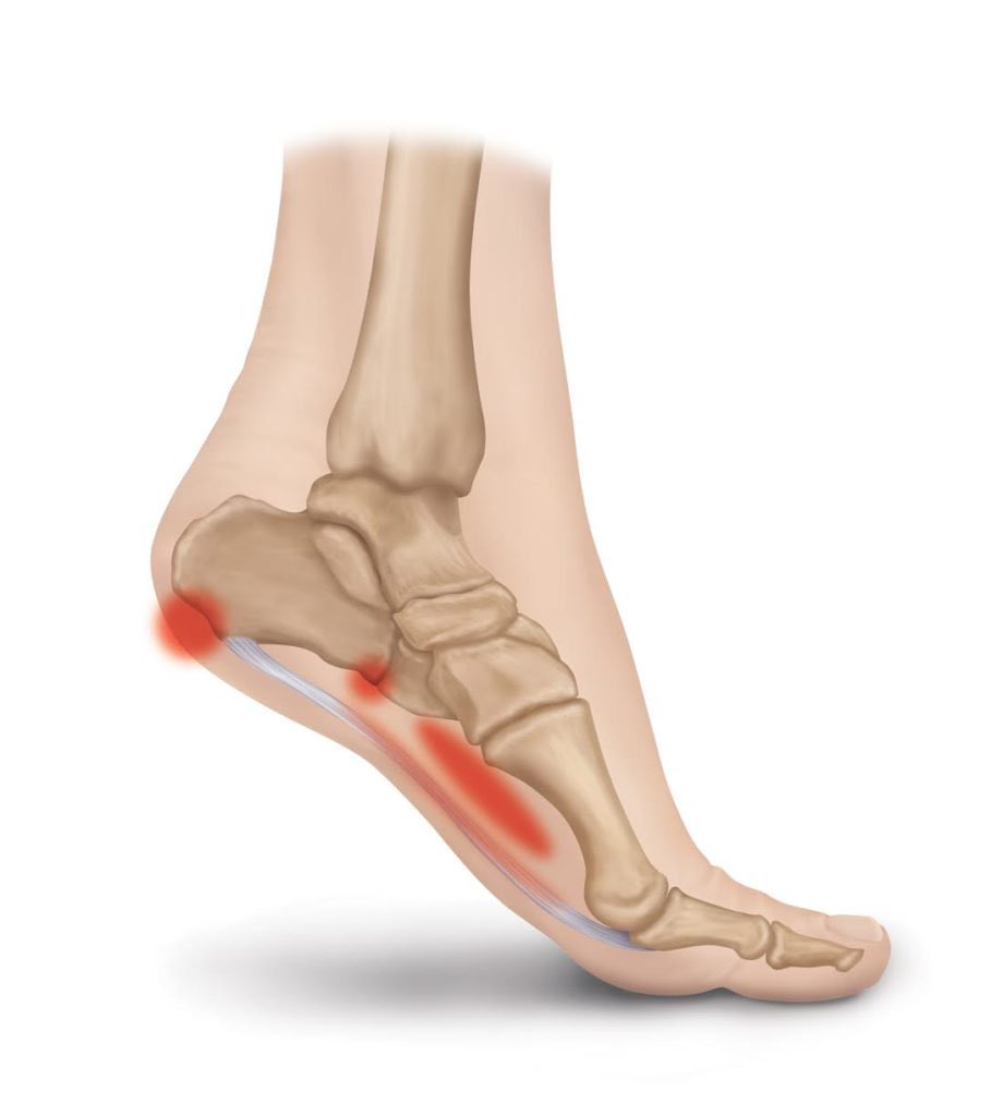 حذاء داعم + تمارين شد أسفل القدم

 = 

وصفة أساسية لتخفيف التهاب اللفافة الأخمصية
Plantar fasciitis 
استمر على الروتين اليومي لتحسن أسرع