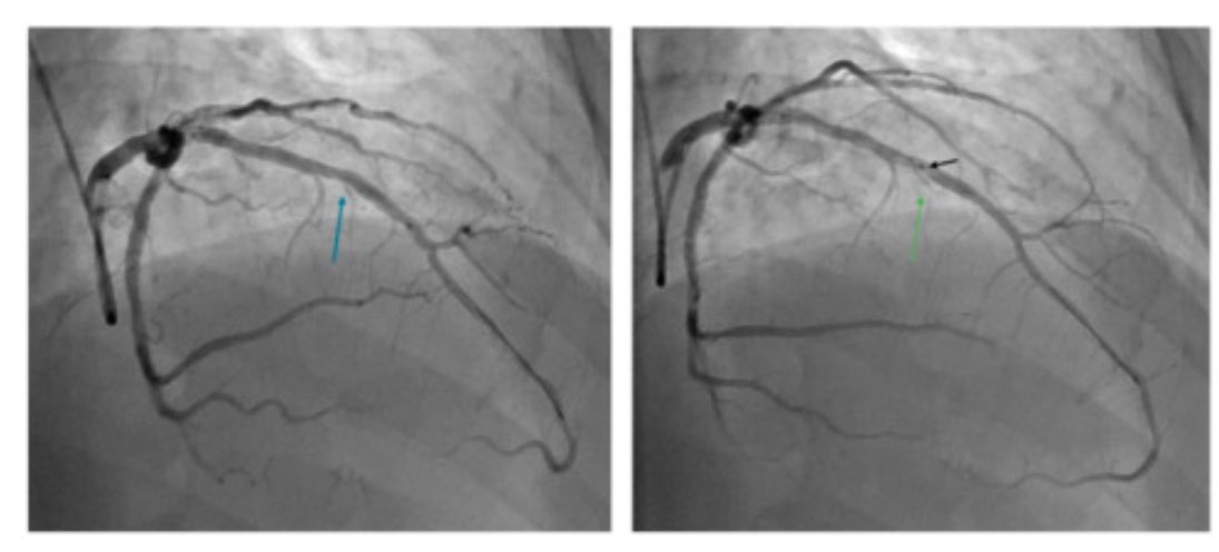 monaltiren's tweet photo. #MyocardialBridge
#CongenitalHeartDisease
#CoronaryPhysiology
#OpticalCoherenceTomography
MYOCARDIAL
B R I D G E :
I C ANATOMICAL &
PHYSIOLOGICAL testing
👇
https://t.co/XURARgGFCr
👋
Som Singh
Sukhdeep Singh Basra https://t.co/CX6pOtOOo4