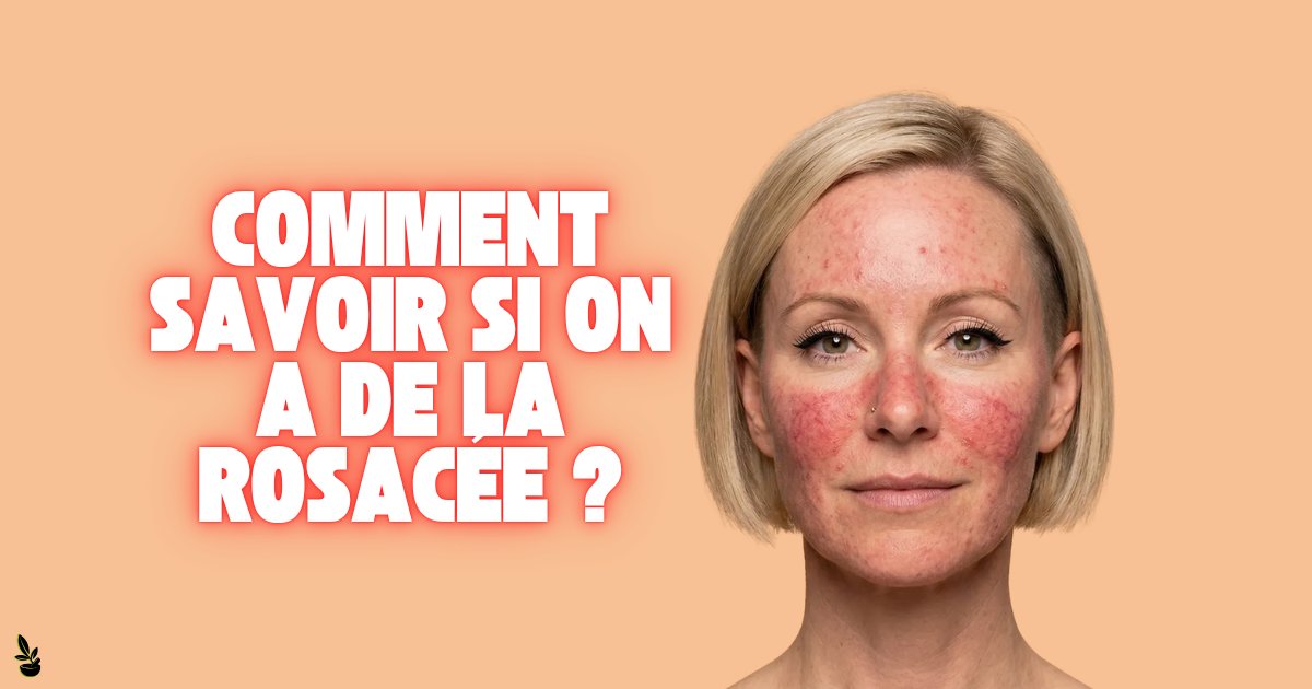 Qu'est-ce qui provoque la #rosacée ? Comment savoir si on a de la rosacée ? Quelle est la différence entre la rosacée et la #couperose ? #rosacea instagram.com/p/DWN_jLoiJ5L/…