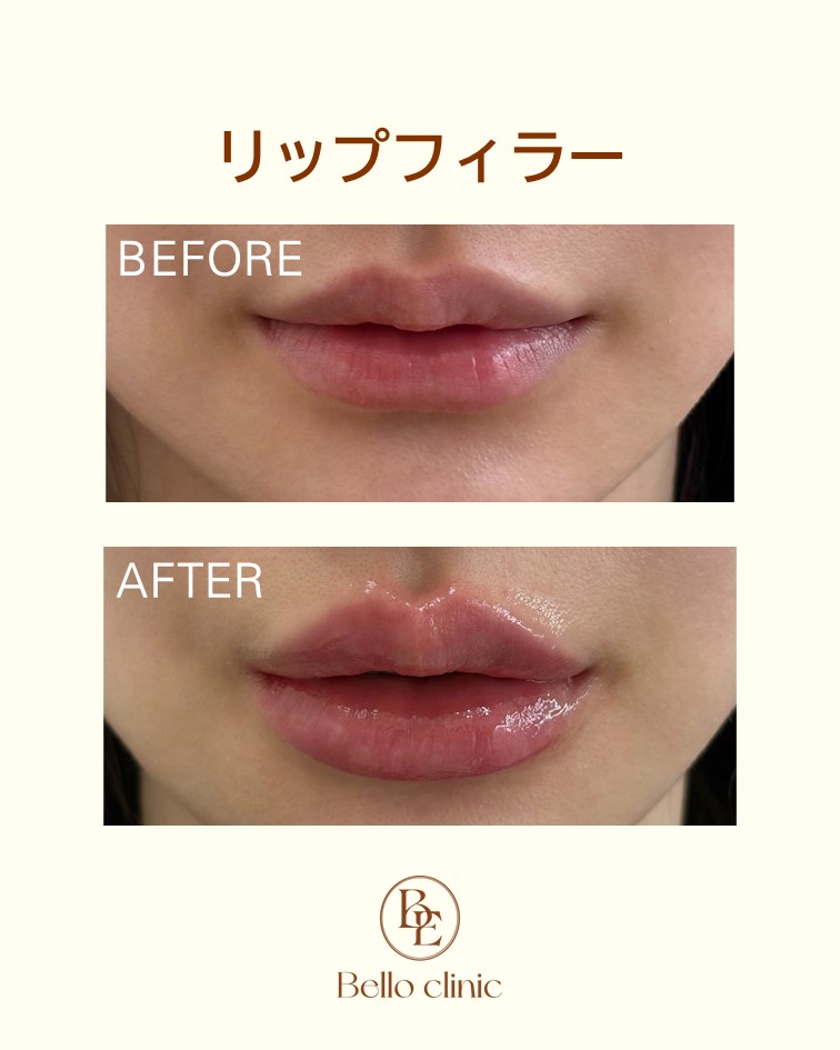 belloclinic's tweet photo. 💋口元の印象変化にリップフィラー
📷 ベロ医院ではアティエルやジュビダーム、
ベロテロによるリップフィラー施術をご提供📷 
📷土日診療OK・お問い合わせはこちら https://t.co/Ee56AL8dRq