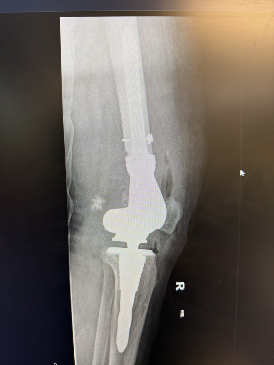 shah_punwar's tweet image. X-rays from last week’s case
DFR tips:
1. Know your system and measure DF resection eg: smallest DF cut is 8 cm for the LPS
2. Prophylactic cable on femur 
3. Check femoral ER to help patella tracking. Mark AP axis before DF resection. 
4. Try not to ream femur eccentrically