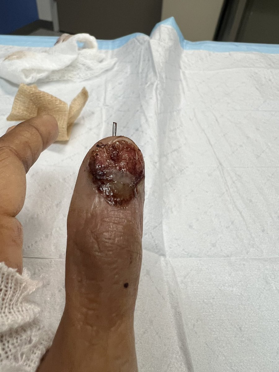 EricaTXRealtor's tweet photo. I should Sue #Subaru  for the #Forester Crushing &amp; Breaking MY THUMB in the door. Damn doors are so heavy, they didn’t leave door jam space to prevent damage. I want payment for my Medical Bills which included Surgery, XRays, Custom Splints #Japan #NotSafe #SubaruForester #USA https://t.co/k1XzUFKLkf